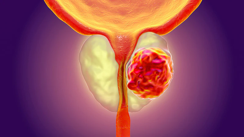 Imagen ilustrativa del cáncer de próstata