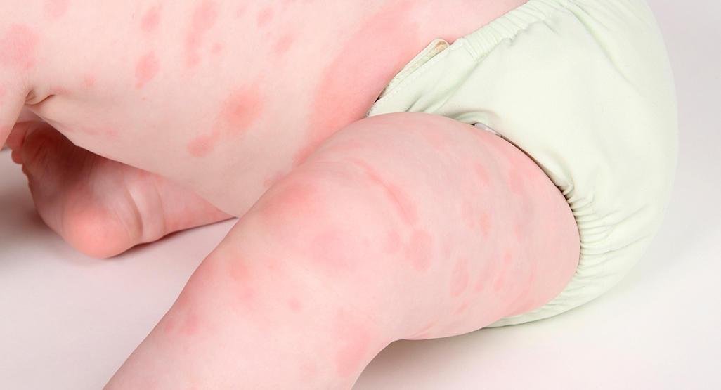 urticaria en bebes