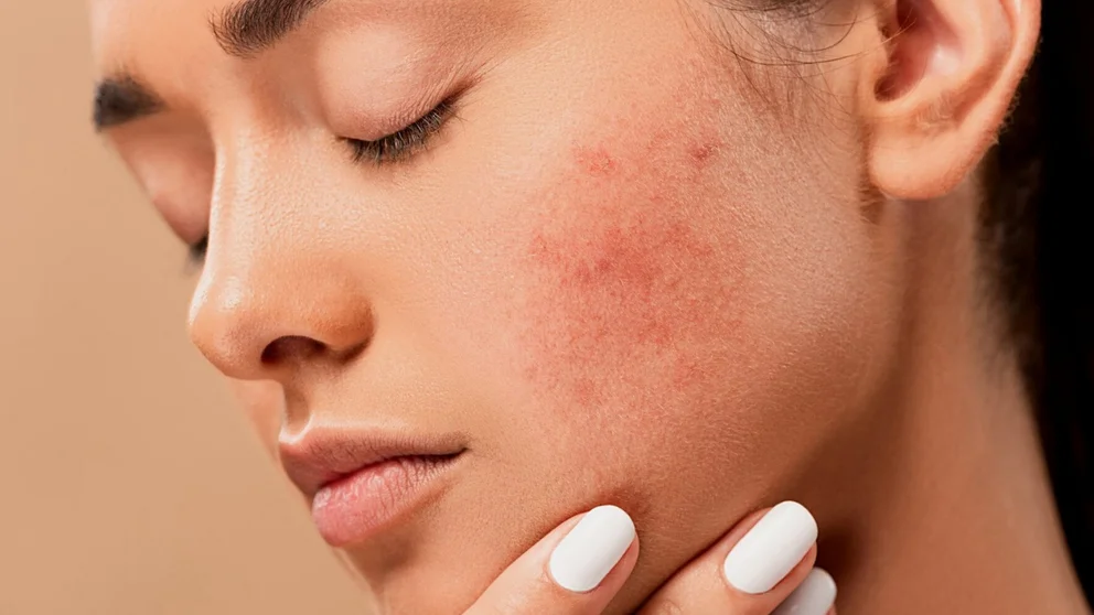 acne juvenil